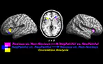 Felt and seen pain evoke the same local patterns of cortical activity in insular and cingulate cortex